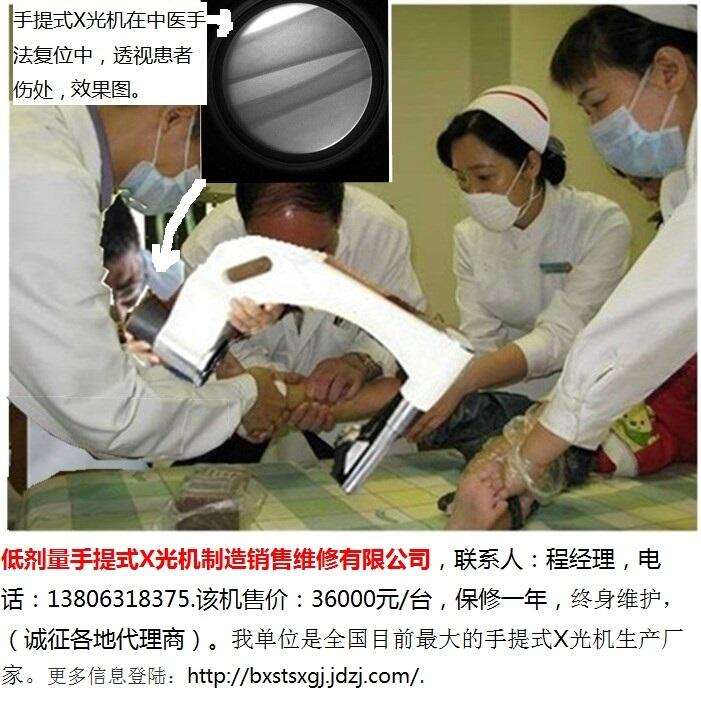 掌骨骨折手法復(fù)位閉合穿針用便攜式X光機(jī)